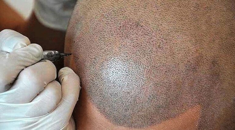 Tricopigmentation à Dijon