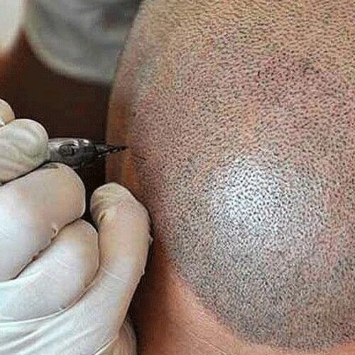 Tricopigmentation à Dijon