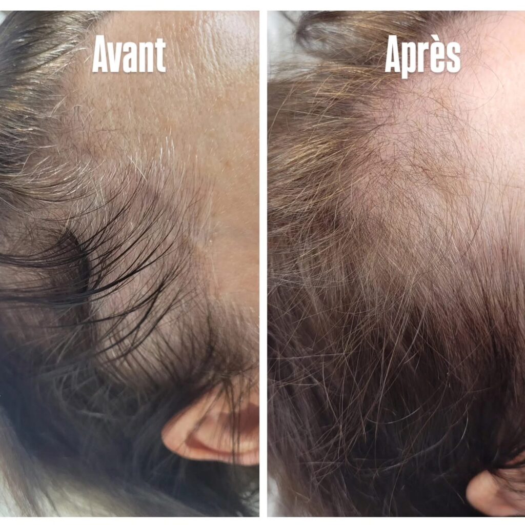 traitement perte de cheveux au sud de Dijon