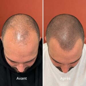Micropigmentation capillaire homme Beaune
