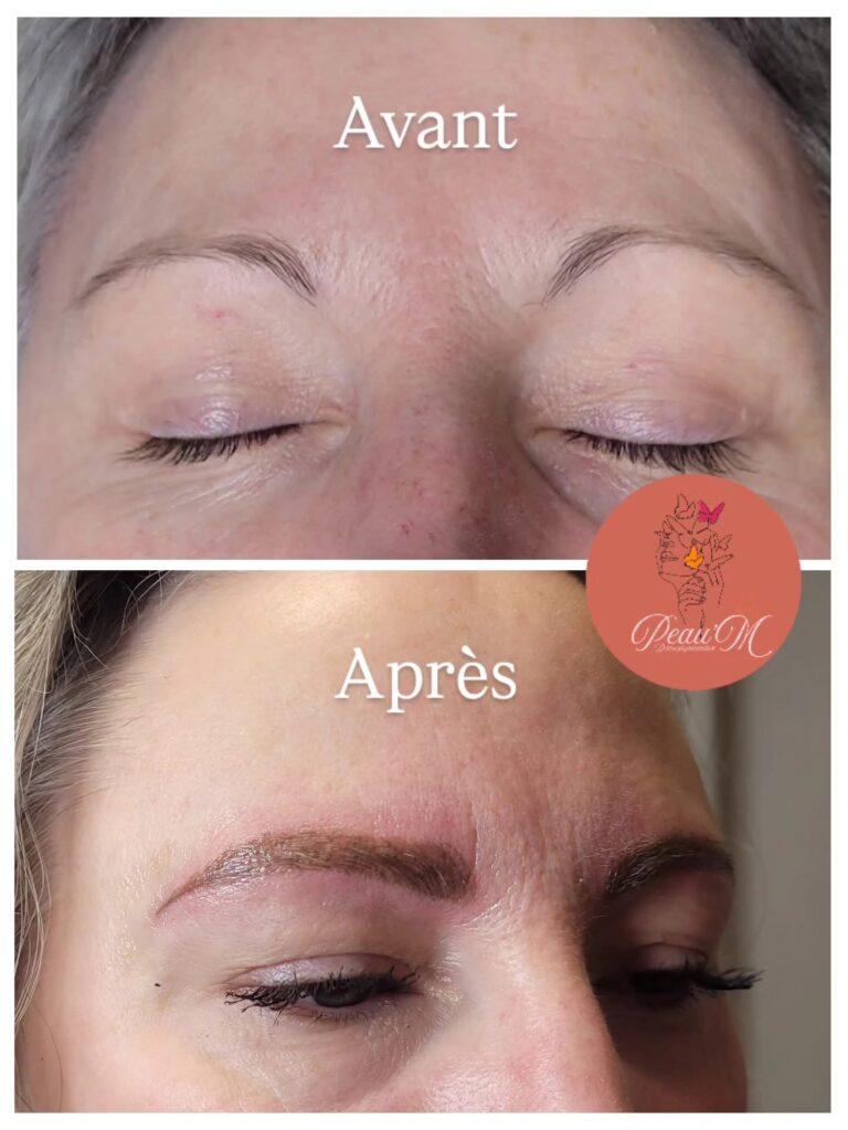 Sourcils clairsemés corrigés par dermopigmentation