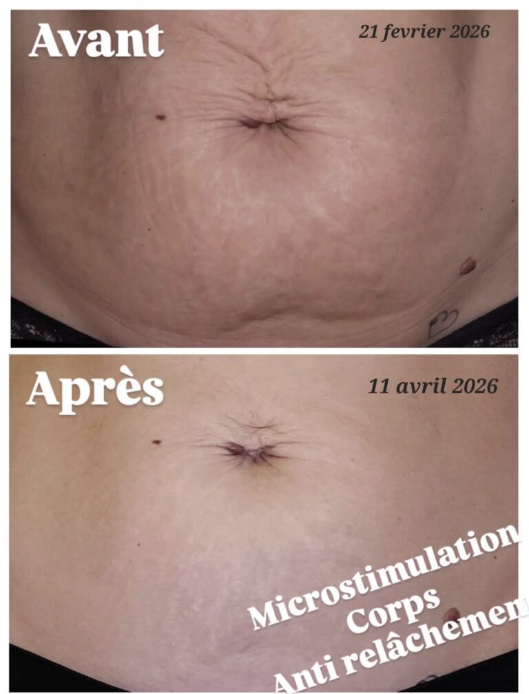 microstimulation corps anti relâchement