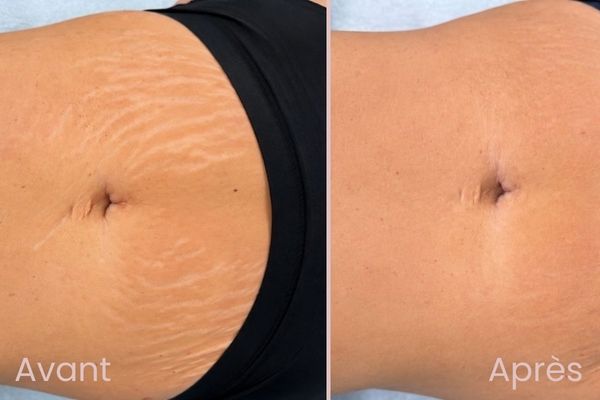 soins du corps anti vergetures