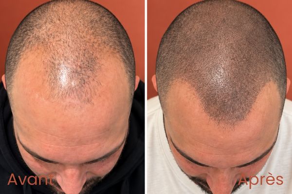 Tricopigmentation capillaire Beaune Nord