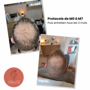 Résultat Tricology avant après