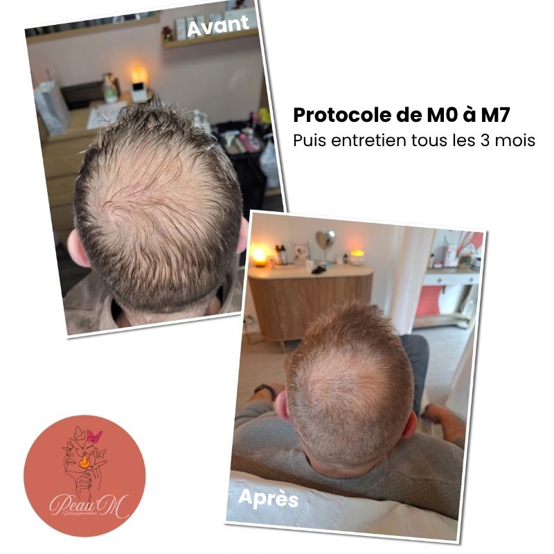 Résultat Tricology avant après